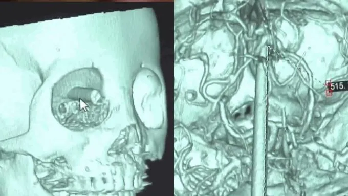 6歲童邊吃邊玩「筷子插眼入腦9cm」奇蹟無大礙