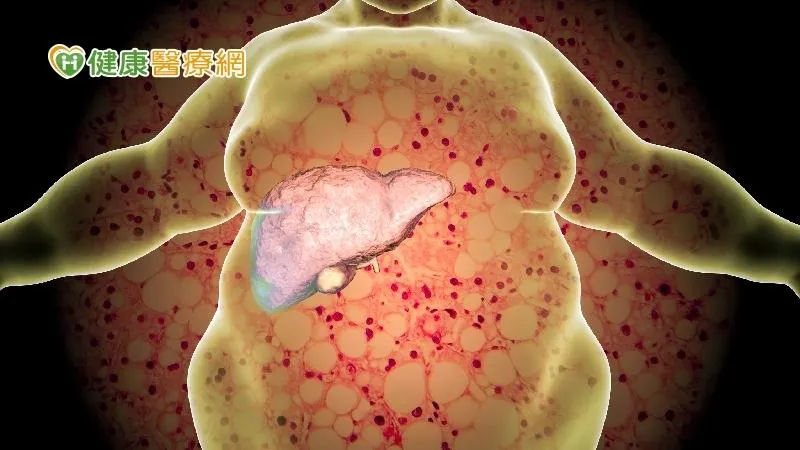 脂肪肝照超音波「看起來油油的」！４旬男肝指數飆破2百「八成都被脂肪堆積！」