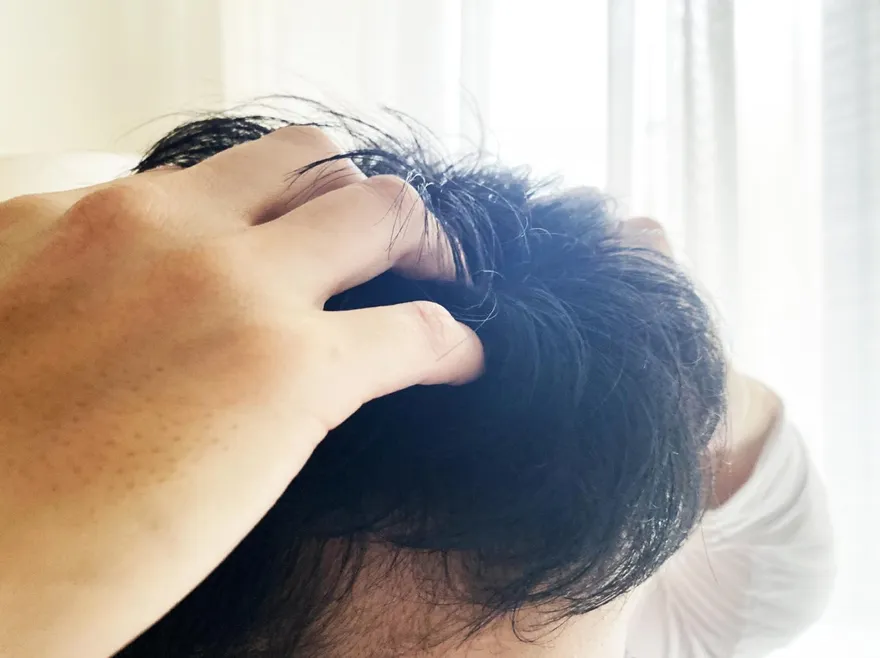 頭皮長痘痘該怎麼辦？6招皮膚攻略　消除頭皮毛囊炎、去痘痘