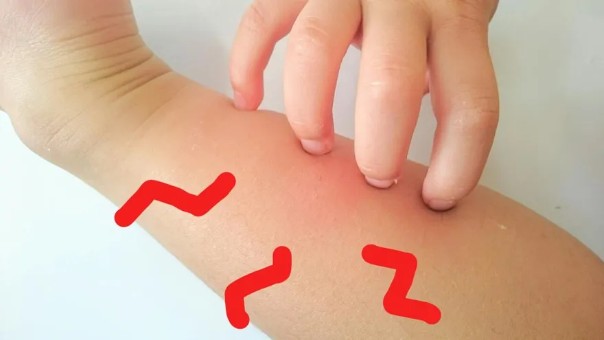 愛吃肉的人容易被蚊子叮？只是迷思！營養師揭3真正原因
