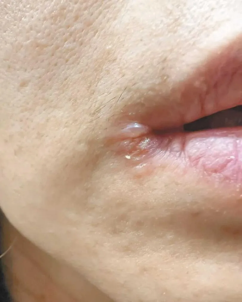 嘴角紅腫刺痛！天冷好發「口角炎」　醫示警：塗口內膏恐惡化