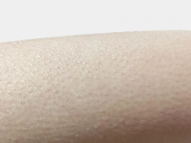 寒冷或恐懼時出現「雞皮疙瘩」是皮膚病？醫揭7原因及3避免方式