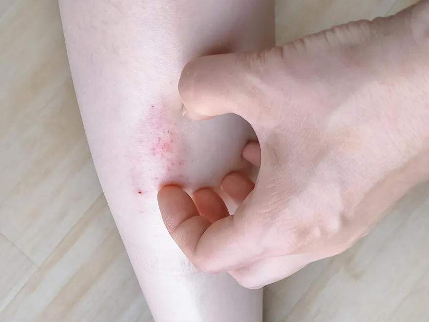 年紀大才出現敏感肌症狀？皮膚科醫揭「4原因」：過度去角質也不行