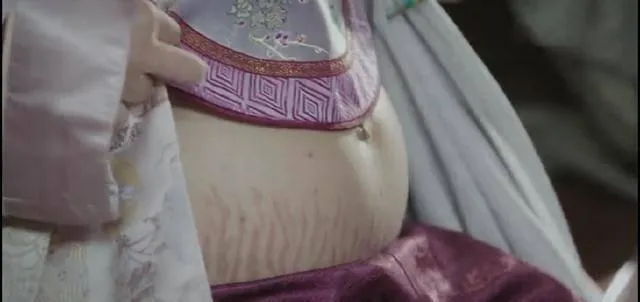 如懿傳「海蘭」被陷害產後「妊娠紋」無法再侍寢！古今都一樣 醫：產後「妊娠紋」看了好憂鬱！