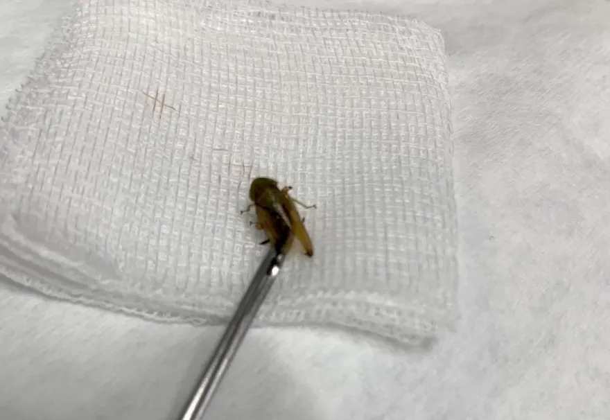 女童耳朵痛！檢查竟是「蟋蟀卡耳道」嚴重恐影響聽力　醫：千萬別自己挖