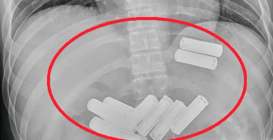 23歲男子吞「11顆3號電池」險腸穿孔！醫花1小時才取出