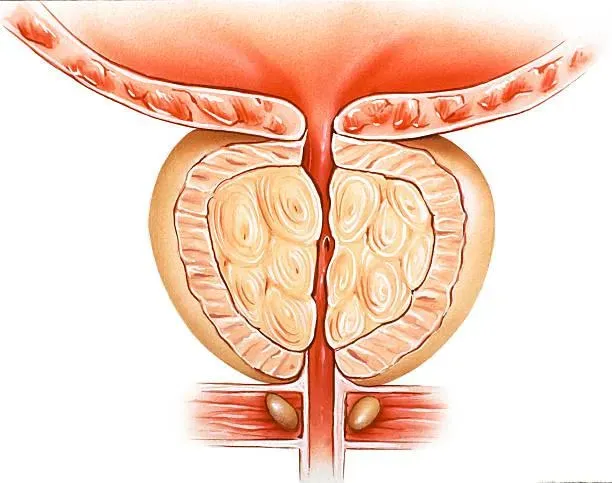常腰痠背痛？他罹「攝護腺癌晚期」8大警訊曝　醫：30%人初診已轉移