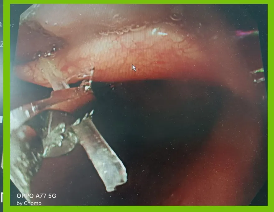 7旬翁「魚刺卡喉嚨」弄不出來！　胃鏡一照醫驚：巨大魚刺整根插入