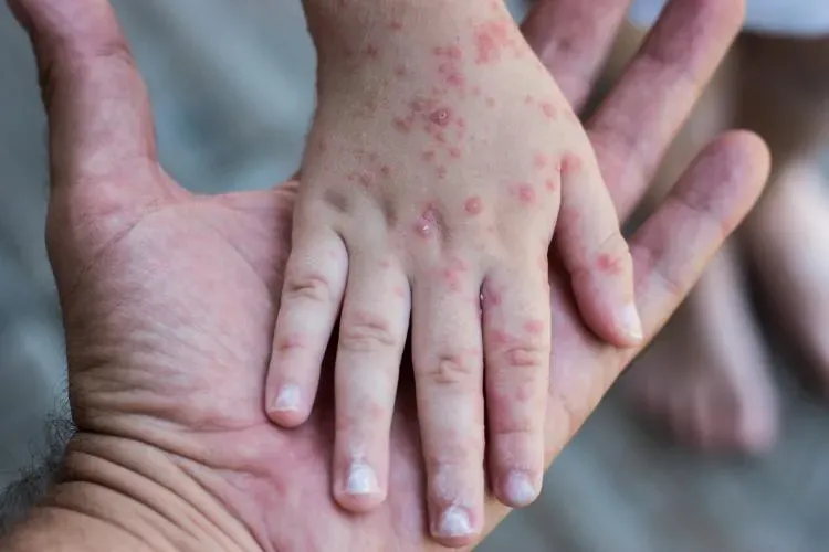 腸病毒下降13.7%仍處流行期！5歲以下嬰幼兒是高危險群