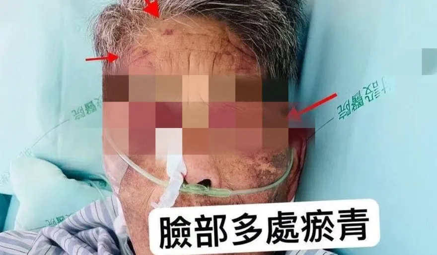影/台中嬤莫名「瘀青」滿身傷　家屬驚見看護揮打氣炸