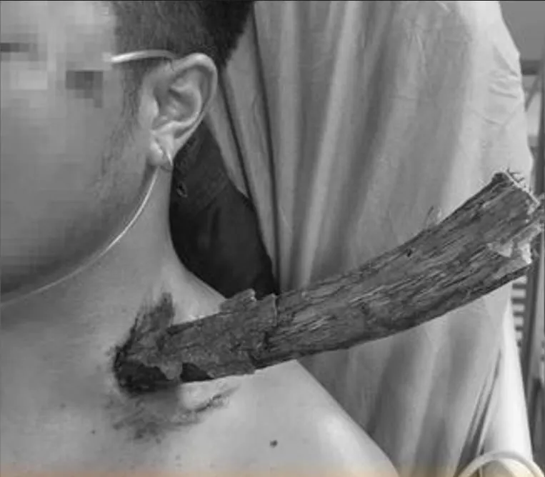 樹下路過「3cm粗」枯枝突插頸穿胸 　陸男因「1事」逃死