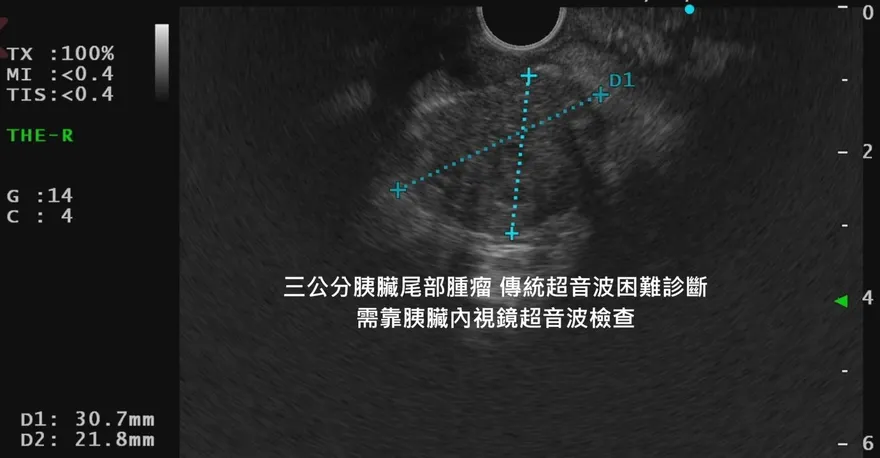 「胰臟癌」潛伏太兇！　醫示警：3種症狀別輕忽