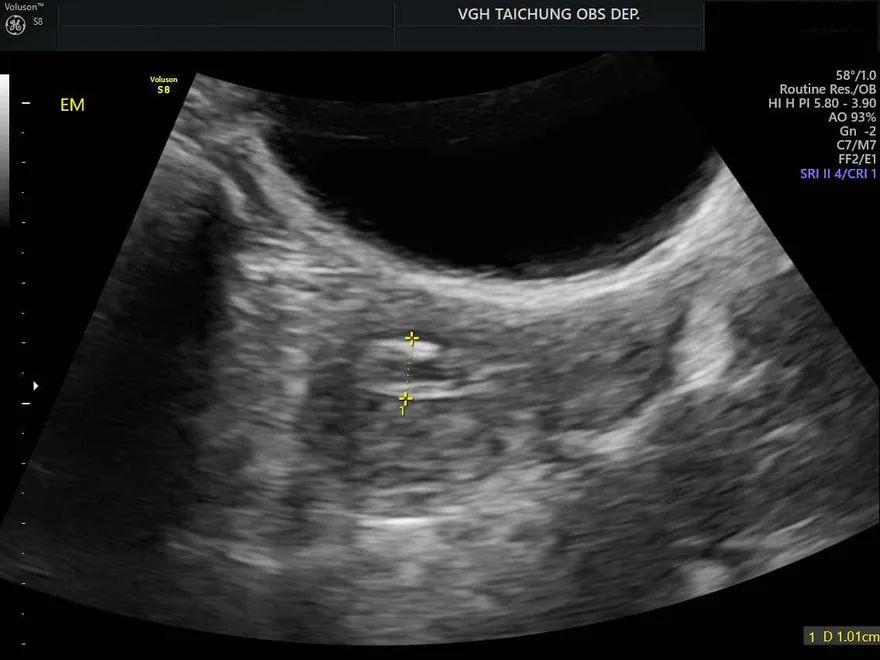 停經多年突然出血？婦以為「回春」檢查竟是子宮內膜癌