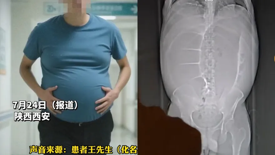 影/滿肚子大便！陸大叔動手術卸載「10分鐘狂排20公斤」
