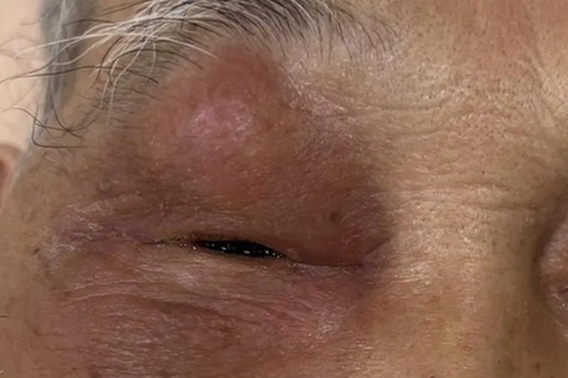 84歲翁「急性鼻竇炎」害眼睛腫脹！醫：嚴重恐致腦膜炎