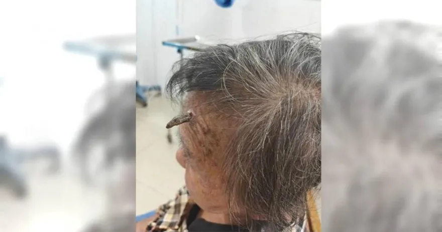 98歲阿嬤「額頭長角」！自剪大出血險喪命