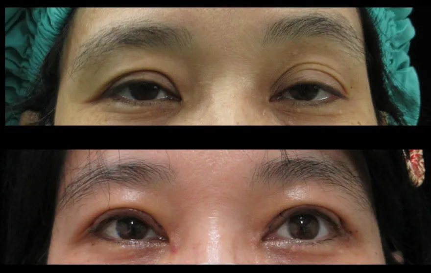 47歲女困擾10年眼瞼下垂　「提眼矯正術」變身美魔女