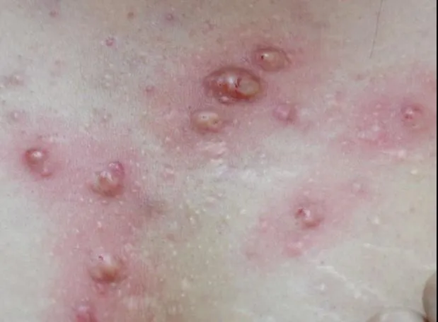 肝功能異常患者福音！「光動力療法」成功治療頑固痘痘