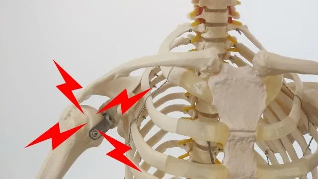 骨鬆恐致死亡率達24%！駝背、變矮、背痛是警訊