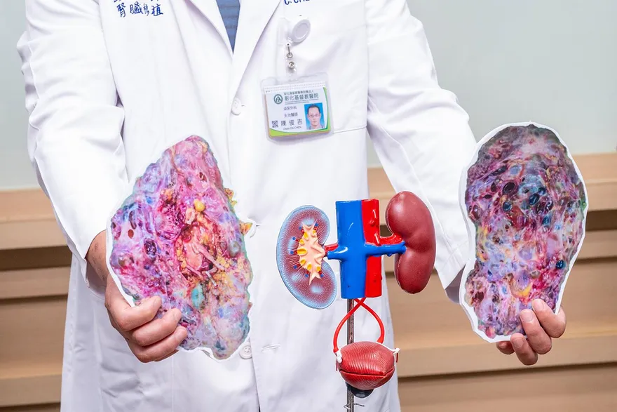 多囊腎「腫20倍」重達6公斤壓迫內臟！靠妹妹捐腎救命