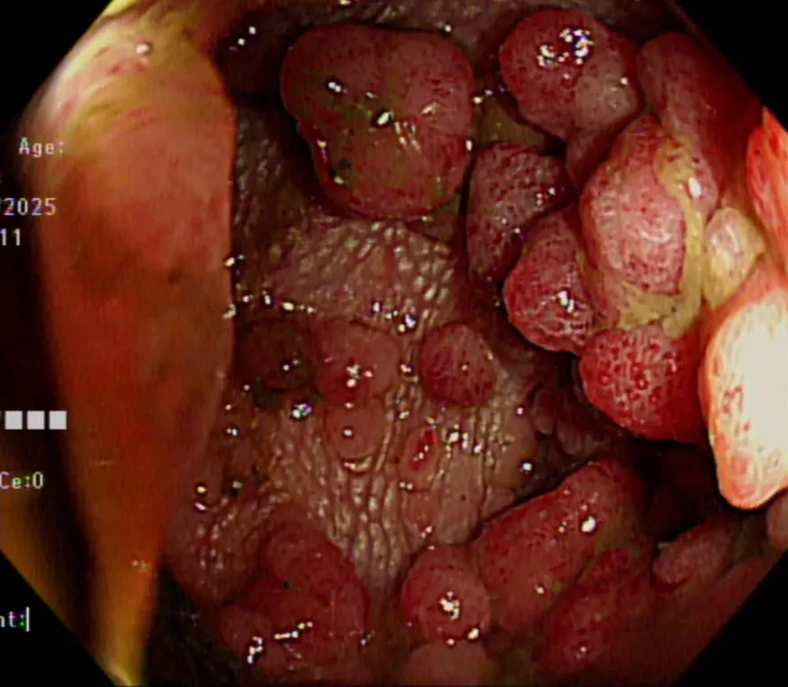 大腸內數百顆瘜肉竟是「致命遺傳」　醫：不治療百分百癌化
