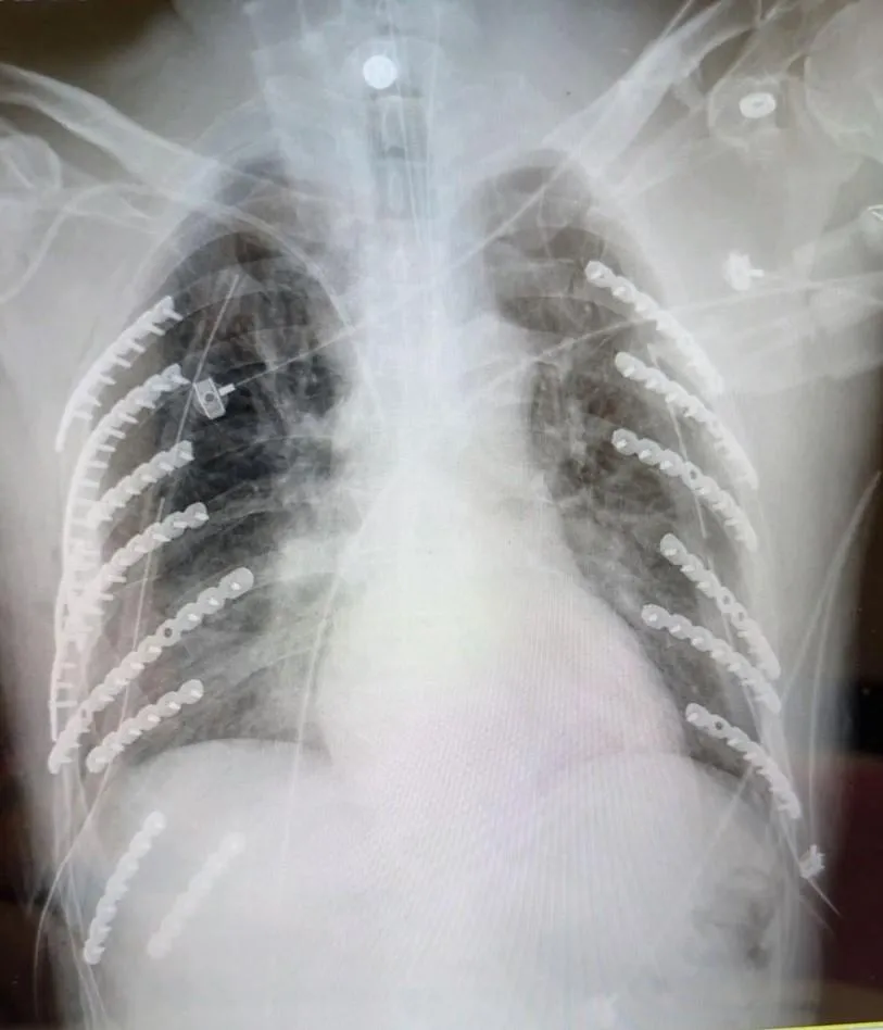 工作車滑坡擠壓！他14根肋骨斷裂險喪命　術後自嘲「變鋼鐵人」