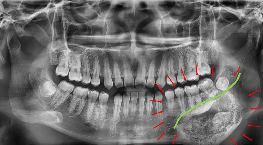 少女「顎骨腫瘤」下顎變形　3D列印精準重建重拾自信