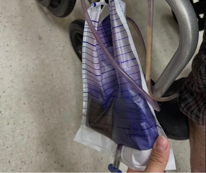 尿袋變紫色非吃錯藥！醫：移除導尿管才能有效控制感染
