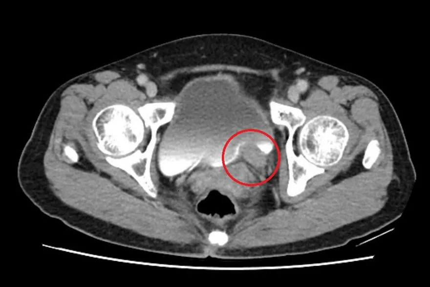 5公分「輸尿管腫瘤」險致腎衰竭！醫：無痛血尿勿輕忽