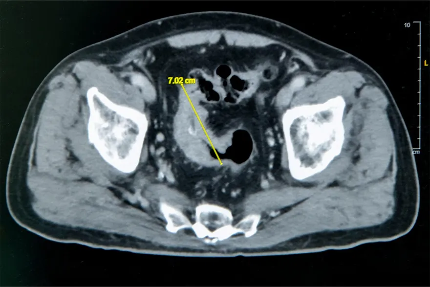 一天有一半時間都在馬桶上！七旬翁便秘竟是7公分大腸癌