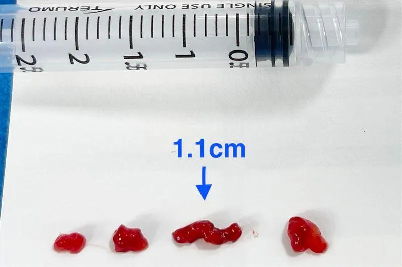 課堂突倒地！國中生心臟長7公分巨瘤　醫急取血栓救命