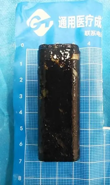 酒後打賭吞下打火機...藏陸男胃30年　醫用「保險套」神救援