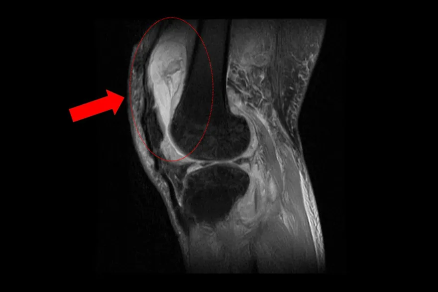 誤以為退化性關節炎　7旬翁膝痛難行竟是「結核菌」感染