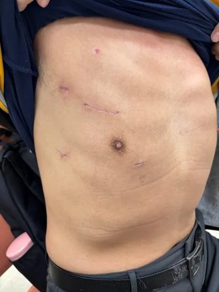 突破心臟手術技術　內視鏡微創瓣膜手術「傷口僅5公分」