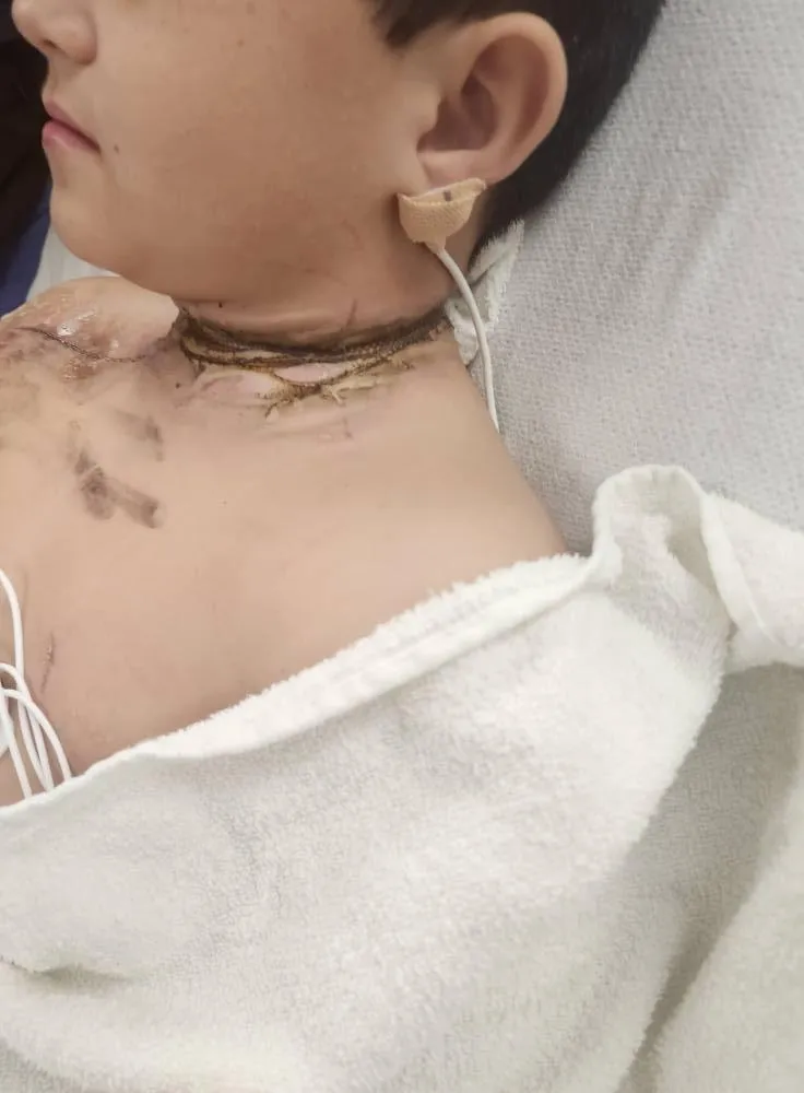 驚悚！睡覺翻身項鏈卡充電器縫隙　美8歲男童觸電燒傷險死