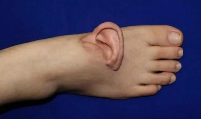 她左耳遭機器扯掉...陸醫手術「寄養」腳背5個月後成功歸位