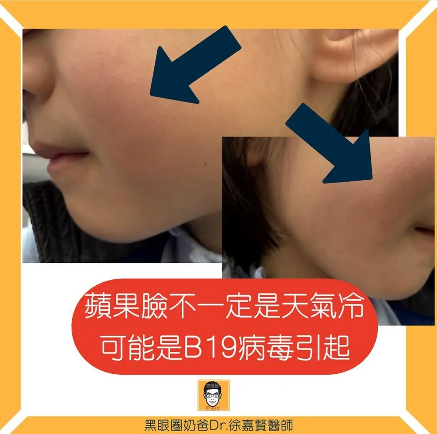 「蘋果病」悄悄回歸！醫師一天遇2例　曝：像被打兩巴掌