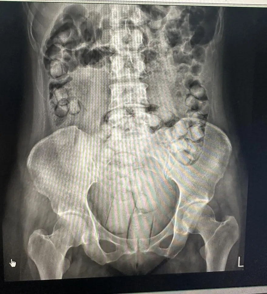 影/小港機場逮人體運毒　2泰女私密處藏市值830萬海洛因