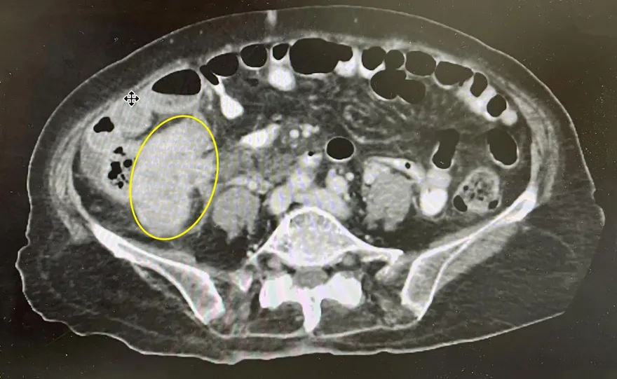 「不想麻煩孩子」婦忍痛數月　醫一看驚：大腸癌腫瘤破了