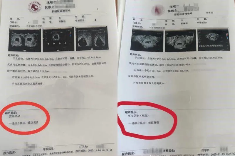 每次產檢多1胎！30歲孕婦懷「同卵四胞胎」　醫驚：超罕見