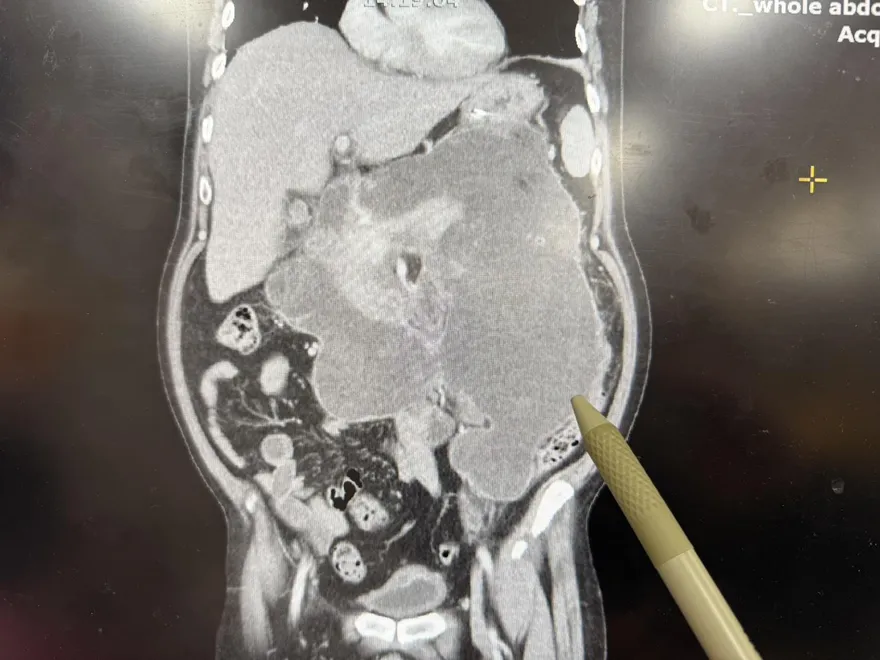 一手啤酒下肚成習慣？川菜主廚戒酒4年還是逃不過胰臟炎