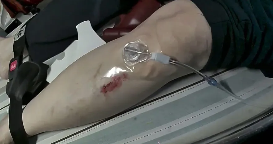 苗栗首例！救護員「骨針」急救OHCA　患者康復出院