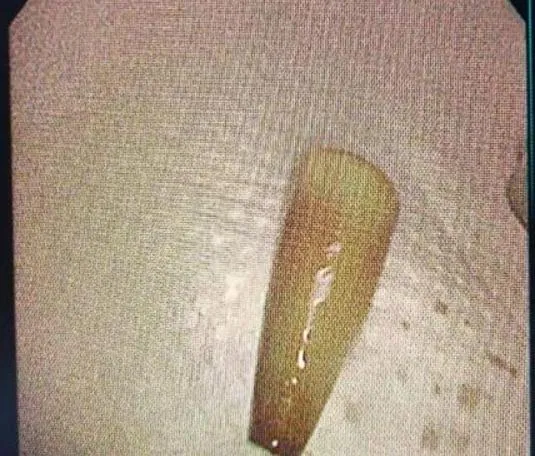 醫師傻了！陸男喝酒嘔吐狂吐血　一查肺部竟卡「原子筆筆蓋」