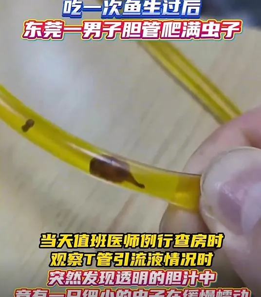 生魚片闖禍！陸男腹痛就醫引流膽汁　赫見「肝吸蟲蠕動」嚇傻醫