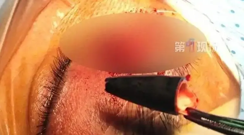 眼痛就醫取出「2.5公分筆頭」　陸男驚：27年前與人爭執被戳