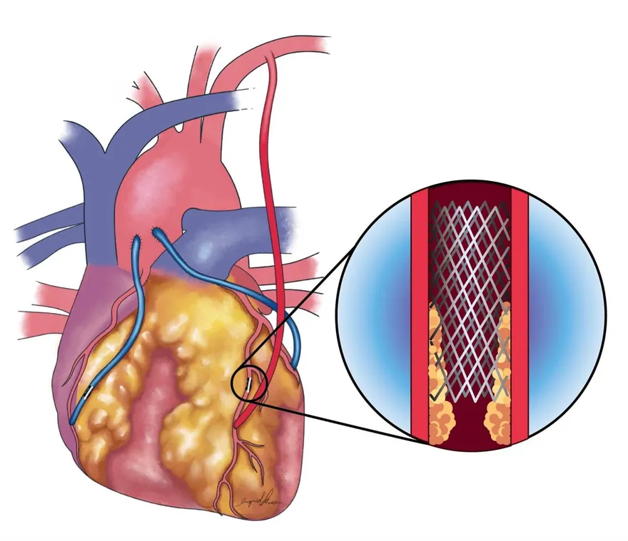 年奪2.3萬命！長庚研究揭心臟治療關鍵　「先放支架再繞道」死亡率增