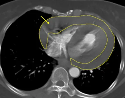 長期頭暈不理會釀大禍！婦「心臟積血合併血管爆裂」搶救