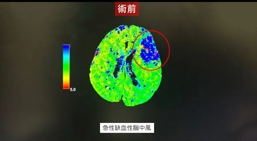 婦腦中風合併顱內動脈瘤！2小時內取栓隔日出ICU