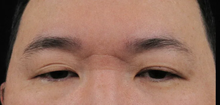 30歲男從小「眼瞼下垂」被霸凌！術後找回自信展開社交