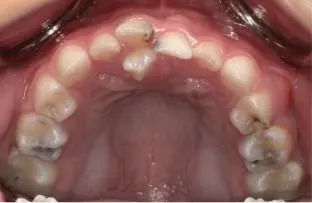 孩子只是換牙慢？醫示警當心「多生牙」影響齒列發育